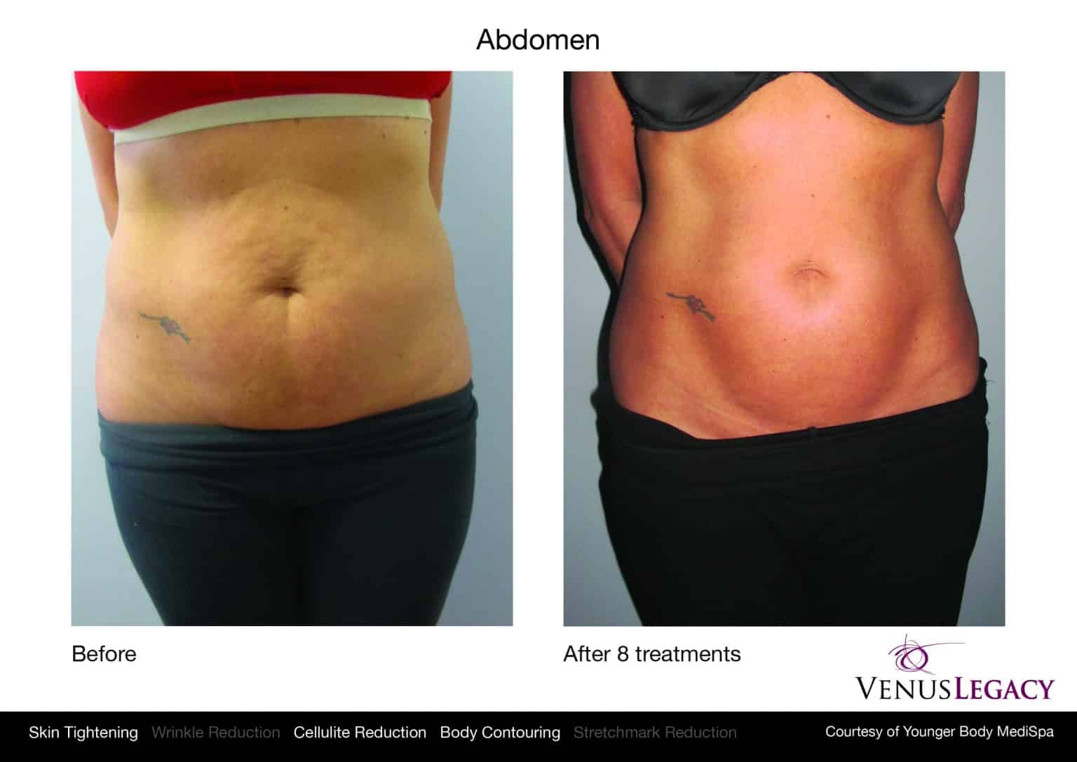 Naperville Venus Freeze Venus Freeze Body Contouring, Skin Tightening Cellulite Reduction