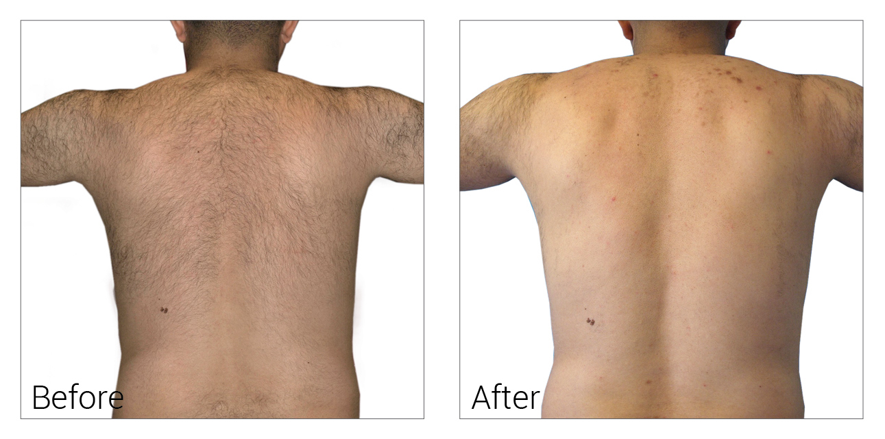 Laser Hair Removal Effectively Eliminate Unwanted Hair Affordable