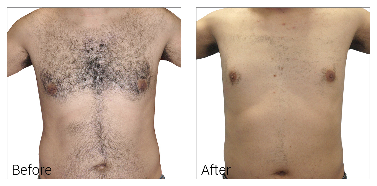 Laser Hair Removal Naperville Plainfield Bolingbrook Affordable Laser Hair Removal Near Me