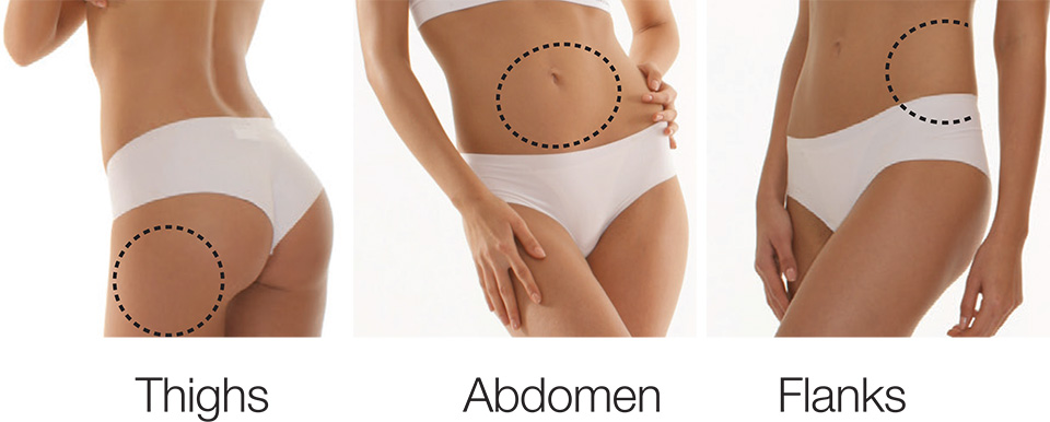 Why we prefer UltraShape Power over CoolSculpting