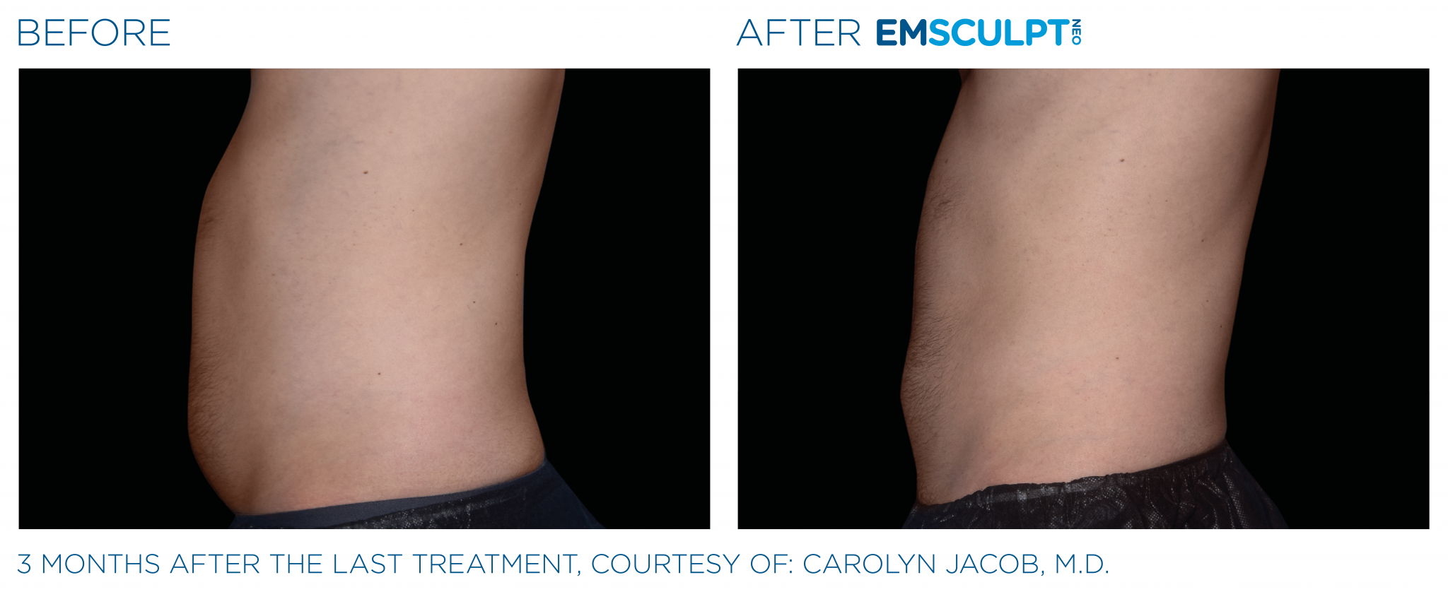emsculpt neo before and after emsculpt neo before and after