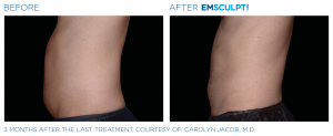 emsculpt