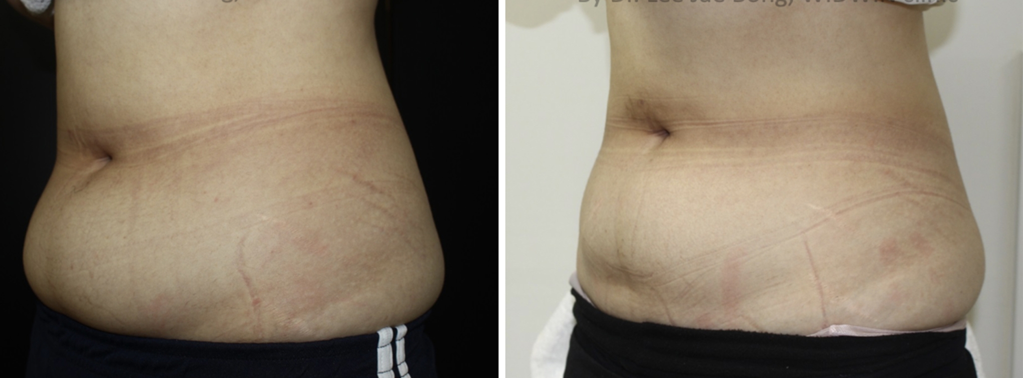 LIPOcel Near Me LIPOcel Permanent Fat Loss & Skin Tightening in Naperville