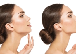 Non-surgical double chin reduction at Fusion Med Spa in Naperville, Illinois