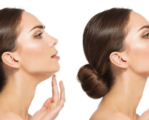 Non-surgical double chin reduction at Fusion Med Spa in Naperville, Illinois