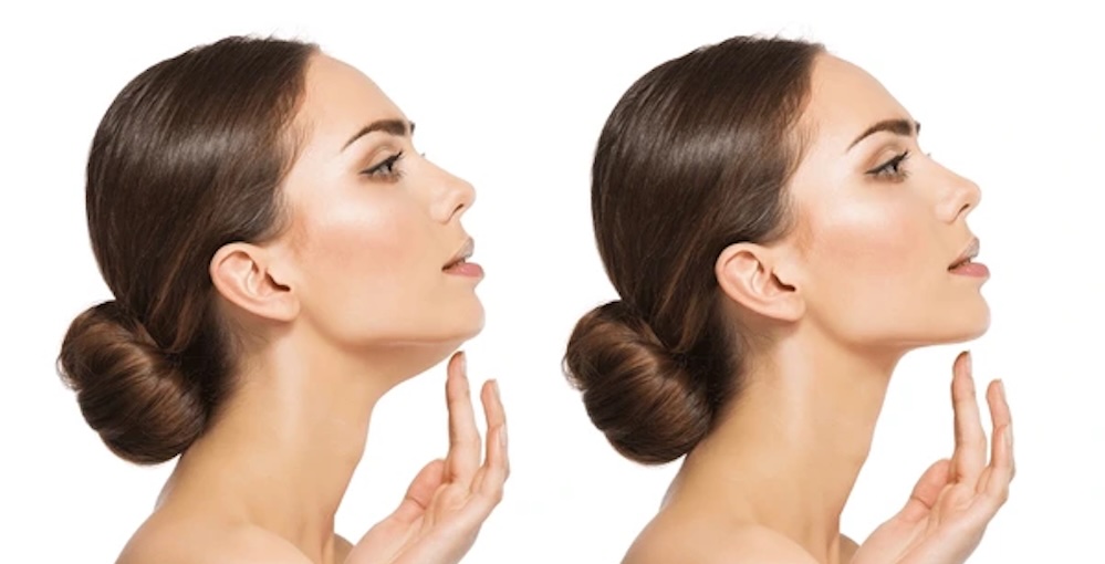 Non-surgical double chin reduction at Fusion Med Spa in Naperville, Illinois