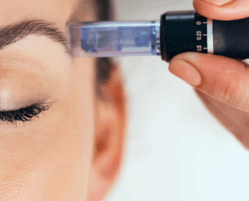 advanced microneedling at Naperville top Med Spa - Fusion Med Spa