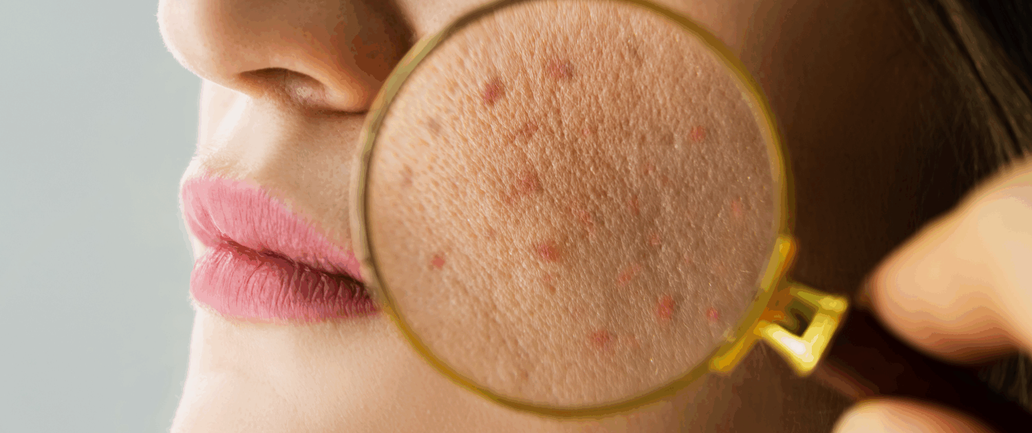 Microneedling for acne scars in Naperville at Fusion Med Spa