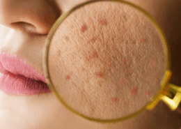 Microneedling for acne scars in Naperville at Fusion Med Spa