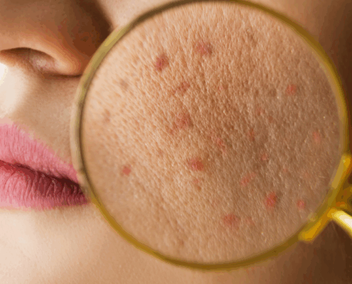 Microneedling for acne scars in Naperville at Fusion Med Spa