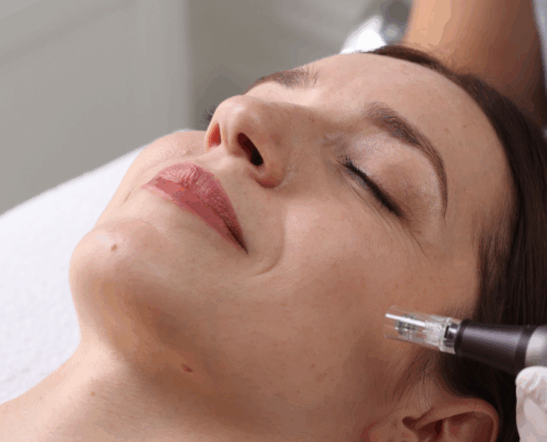 microneedling for fine lines and wrinkles at Fusion Med Spa in Naperville