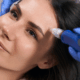 SkinPen Naperville - Microneedling