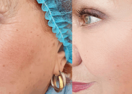 Fusion Med Spa in Naperville has the best treatments for brown spots and hyper pigmentation