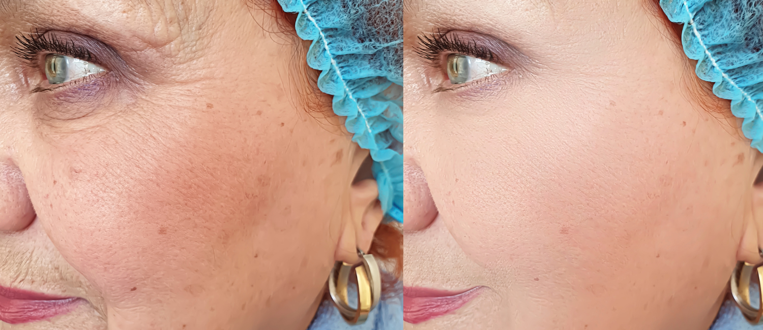 Fusion Med Spa in Naperville has the best treatments for brown spots and hyper pigmentation