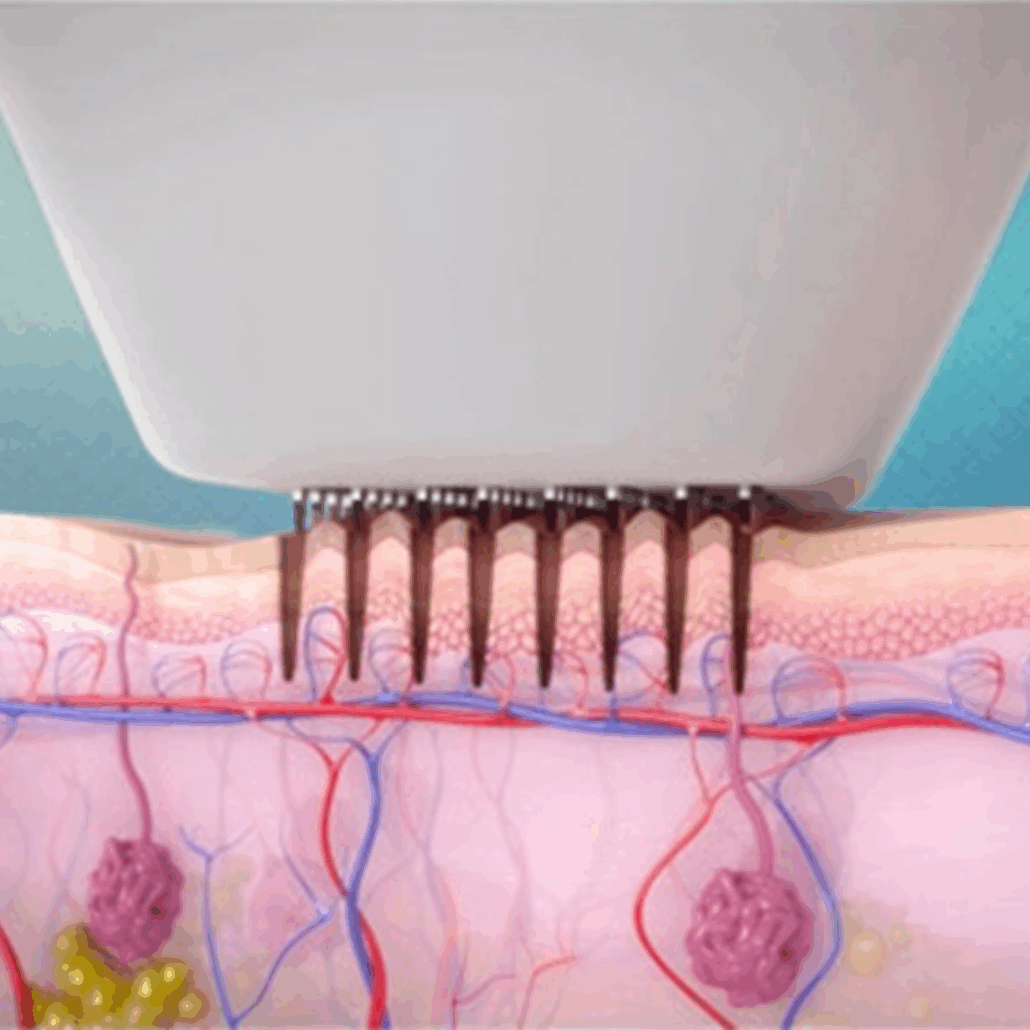 How Venus Viva Microneedling works at fusion Med Spa in Naperville