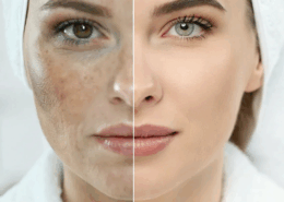 Best Vi Peel in Naperville at Fusion Med Spa