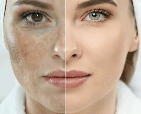 Best Vi Peel in Naperville at Fusion Med Spa