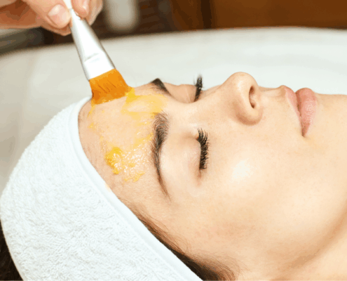 chemical peels for dark spots and hyperpigmentation in naperville available at Fusion Med Spa