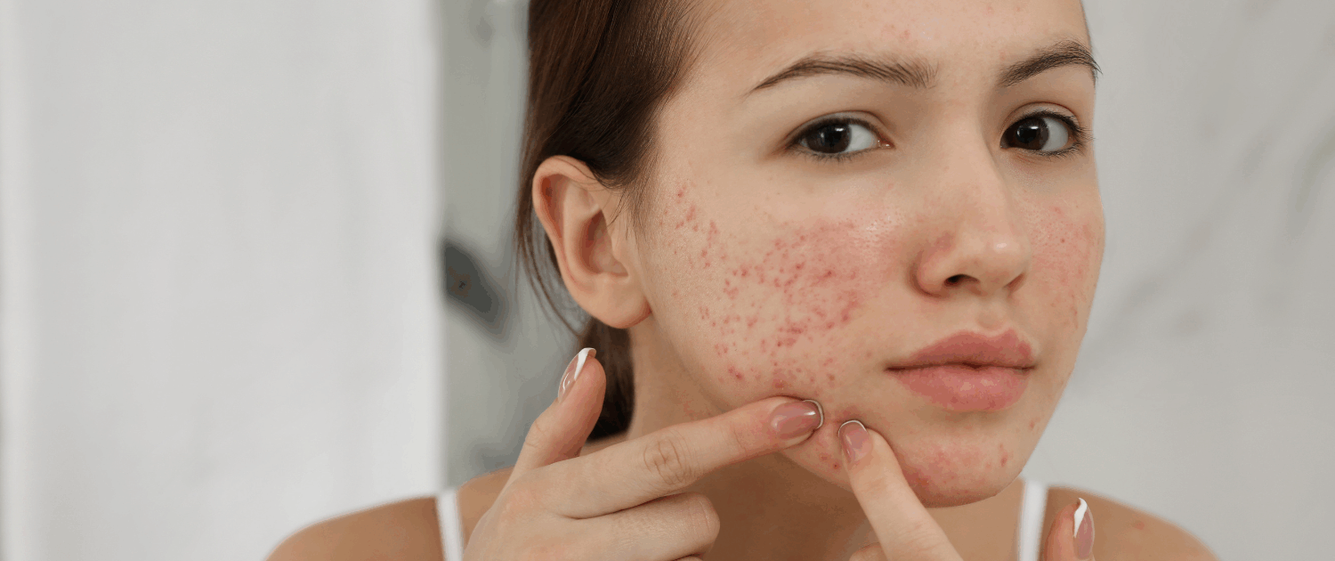 chemical peels to get rid of acne in naperville at Fusion Med Spa