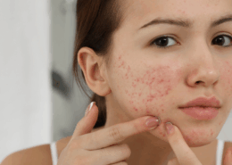 chemical peels to get rid of acne in naperville at Fusion Med Spa