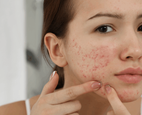 chemical peels to get rid of acne in naperville at Fusion Med Spa