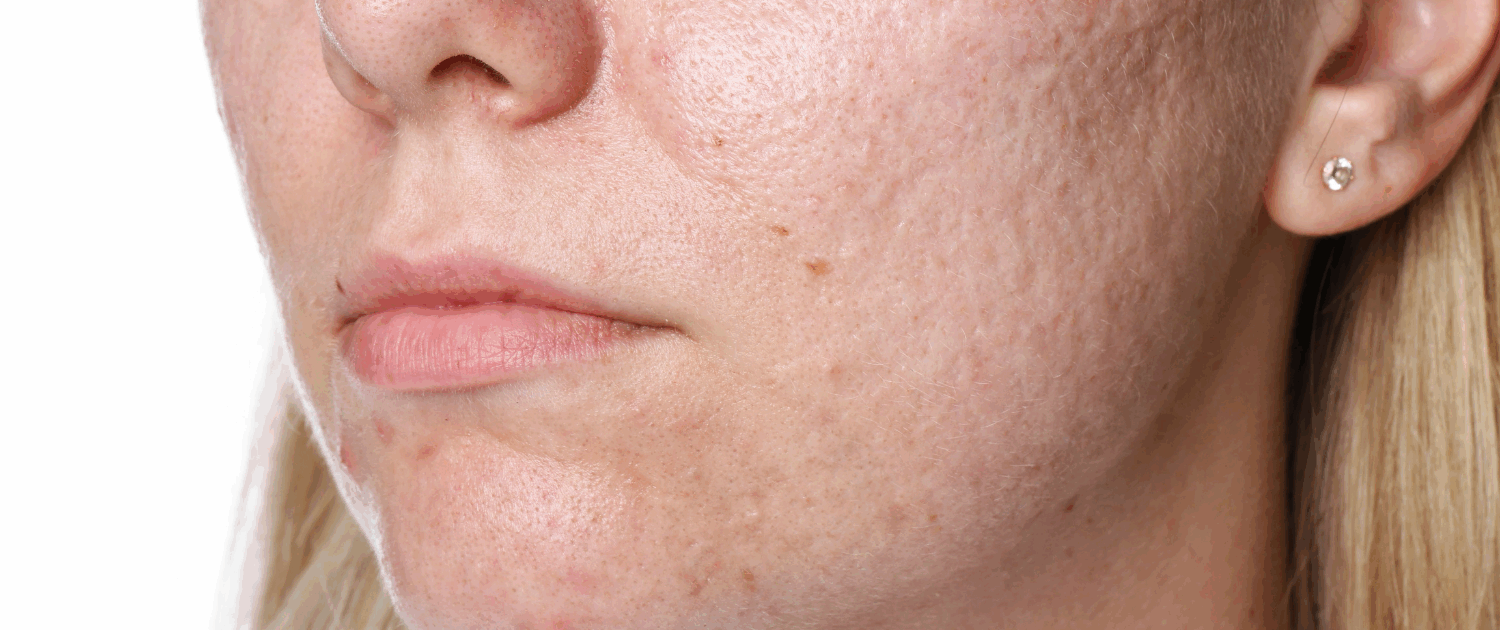 get rid of acne scarring with chemical peels in naperville il