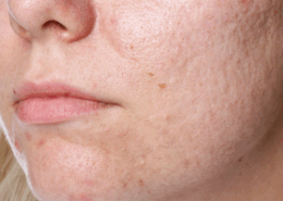 get rid of acne scarring with chemical peels in naperville il
