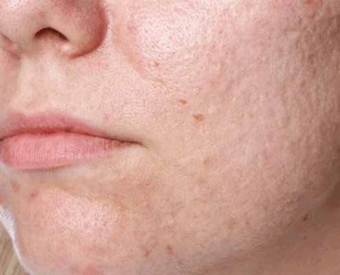 get rid of acne scarring with chemical peels in naperville il