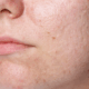 get rid of acne scarring with chemical peels in naperville il
