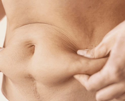 skin tightening in naperville il