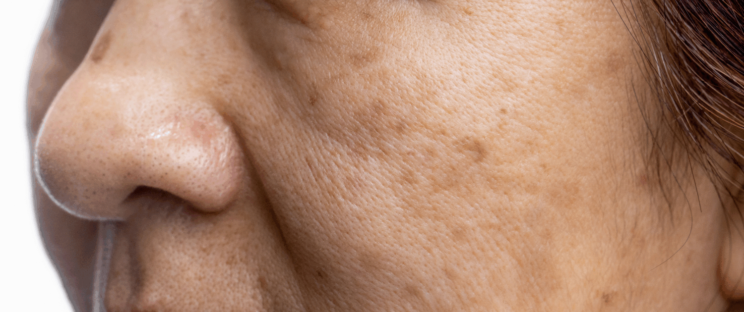 Microneedling for age spots and hyperpigmentation at Fusion Med Spa in Naperville IL 4931 Rte 59 #119 Naperville IL 60564 (630) 451-8509