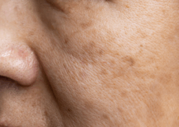 Microneedling for age spots and hyperpigmentation at Fusion Med Spa in Naperville IL 4931 Rte 59 #119 Naperville IL 60564 (630) 451-8509