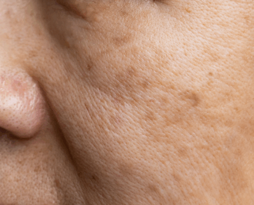 Microneedling for age spots and hyperpigmentation at Fusion Med Spa in Naperville IL 4931 Rte 59 #119 Naperville IL 60564 (630) 451-8509