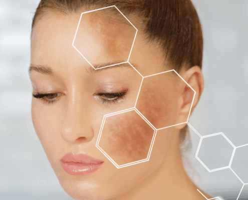 fusion Med Spa offers the best microneedling for melanoma in naperville