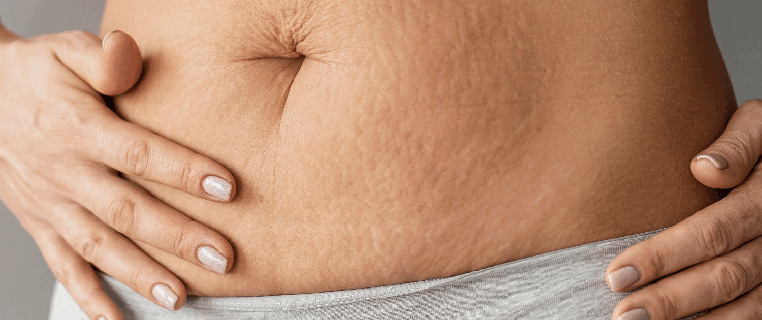 best microneedlng treatments for stretch marks in naperville at Fusion Med Spa