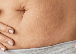 best microneedlng treatments for stretch marks in naperville at Fusion Med Spa