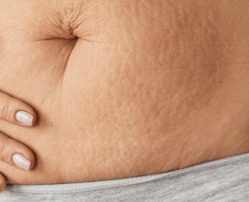 best microneedlng treatments for stretch marks in naperville at Fusion Med Spa