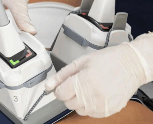Fusion Med Spa in naperville offers effective CoolSculpting alternatives