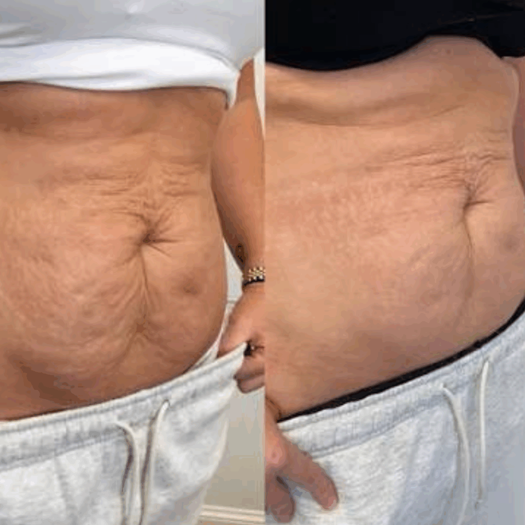 Fusion Med Spa ofers the best treatments for loose and saggy skin in naperville il