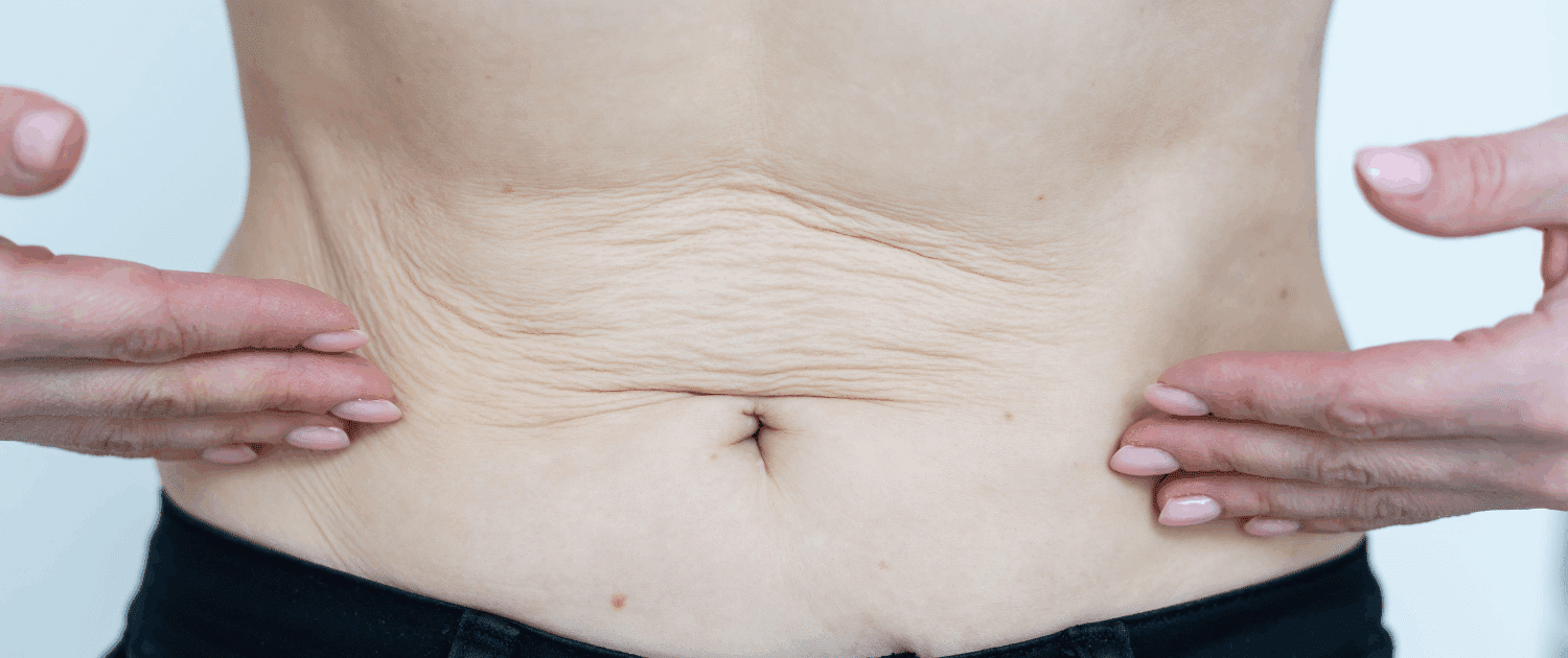 saggy skin in naperville il best saggy skin treatments in naperville at Fusion Med Spa