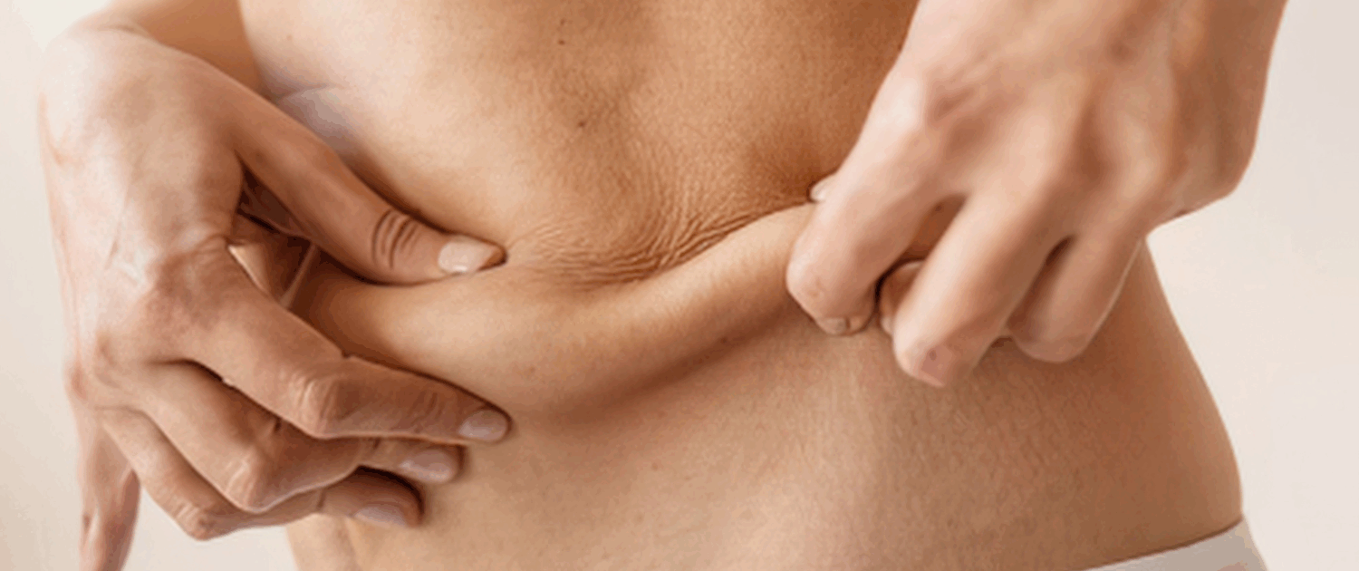 saggy skin or fat in naperville il saggy skin or loose skin in naperville il - fusion med spa can help you get rid of it