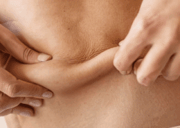 saggy skin or loose skin in naperville il - fusion med spa can help you get rid of it